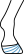 Horse hoof deformities, including abnormal hoof growth rings